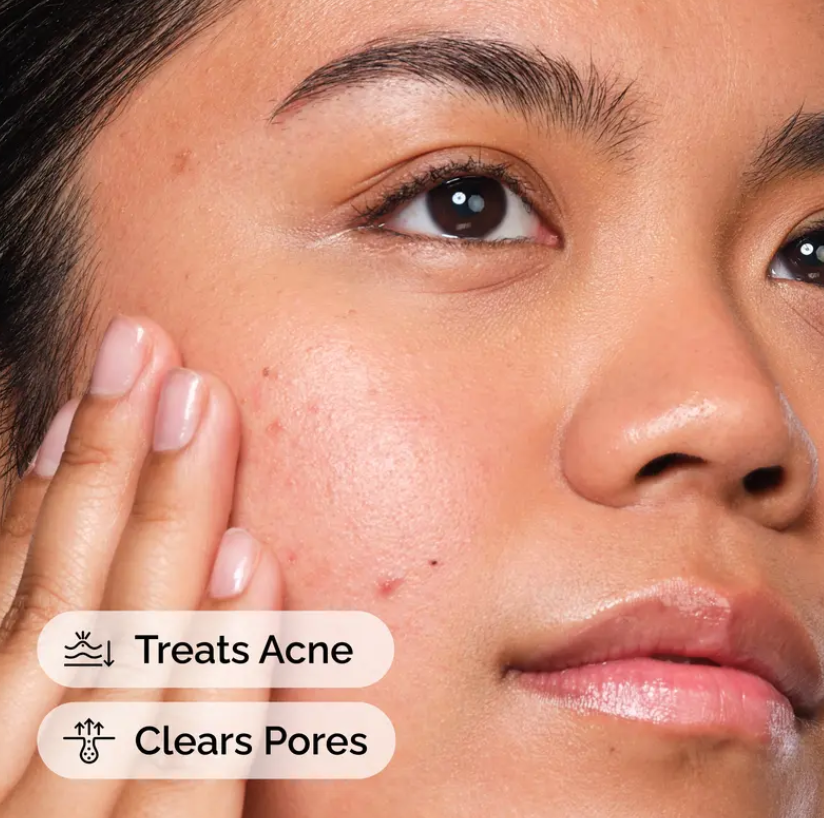 The Acne Set